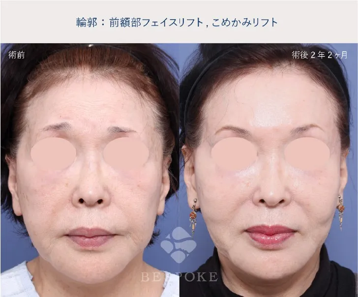 前額リフトの女性の症例