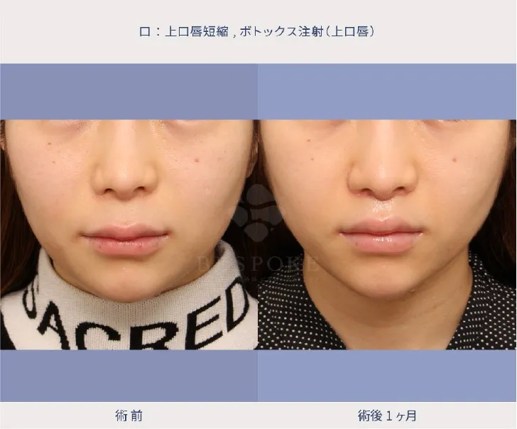上口唇短縮術（人中短縮術）の女性の症例