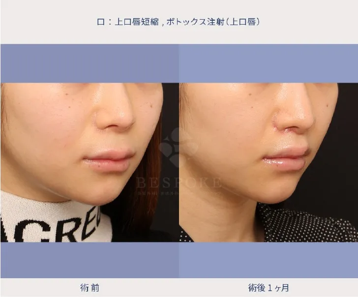 上口唇短縮術（人中短縮術）の女性の症例