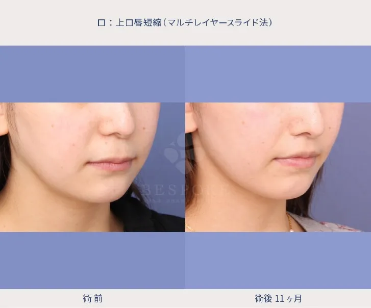 上口唇短縮術（人中短縮術）の女性の症例