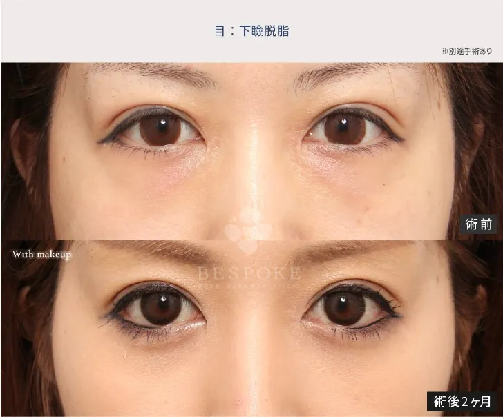 下眼瞼脱脂の女性の症例