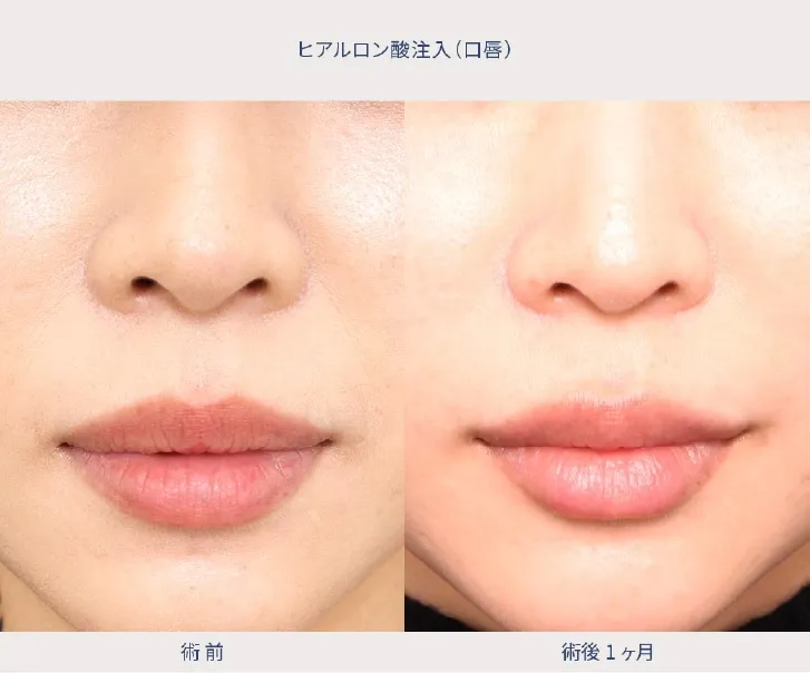 ヒアルロン酸注入の女性の症例