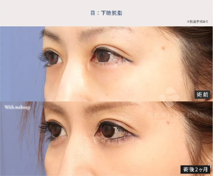 下眼瞼脱脂の女性の症例