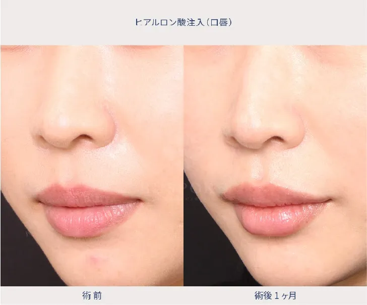 ヒアルロン酸注入の女性の症例