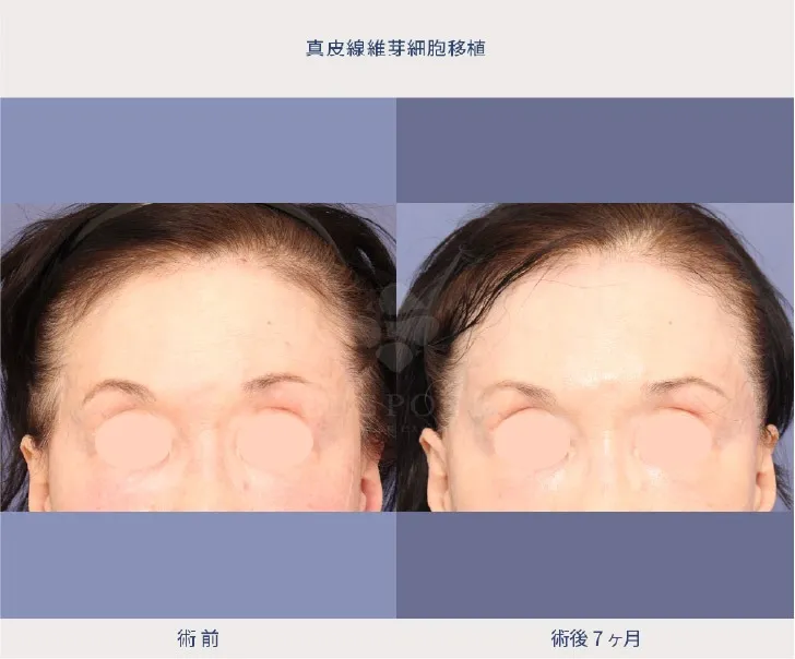 真皮線維芽細胞移植術の女性の症例