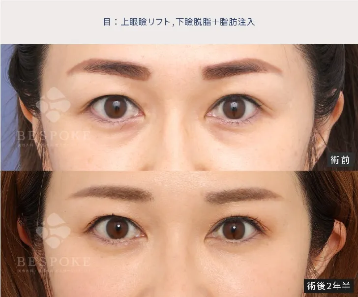 下眼瞼脱脂の女性の症例