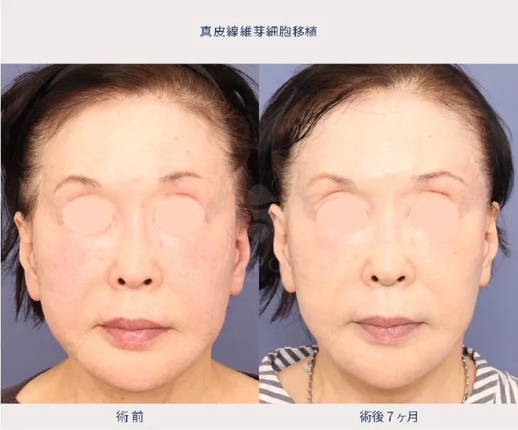 真皮線維芽細胞移植術の女性の症例