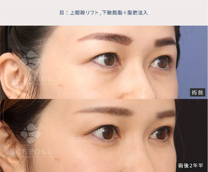 下眼瞼脱脂の女性の症例