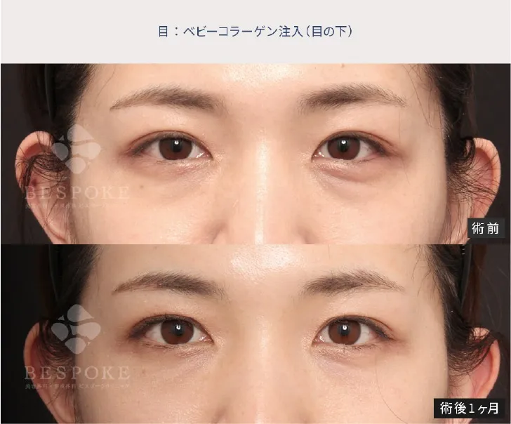 下眼瞼脱脂の女性の症例