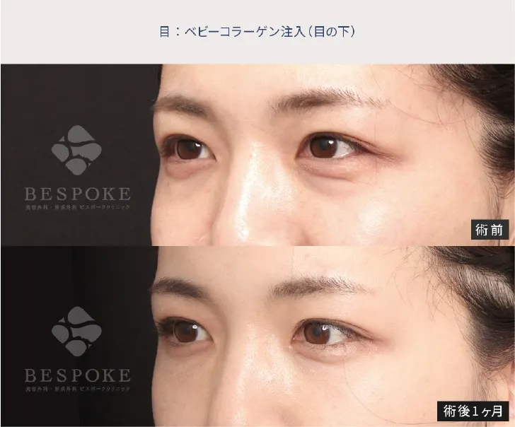 下眼瞼脱脂の女性の症例