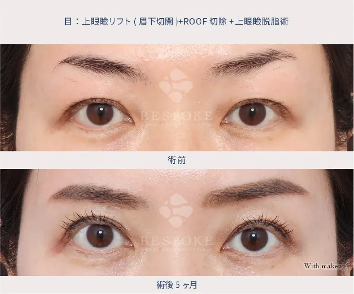 上眼瞼リフト（眉下切開）の女性の症例
