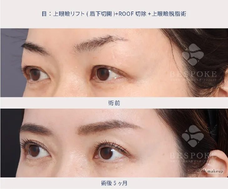 上眼瞼リフト（眉下切開）の女性の症例