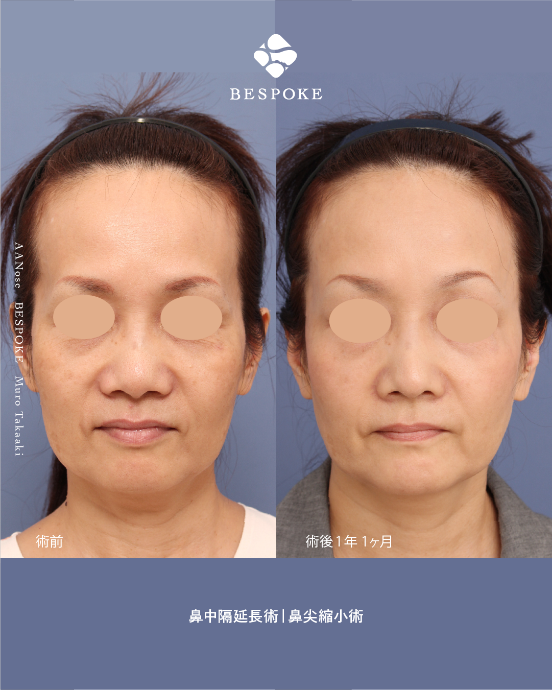 【鼻中隔延長術＋鼻尖縮小術】加齢で広がる鼻を、若々しい印象へ