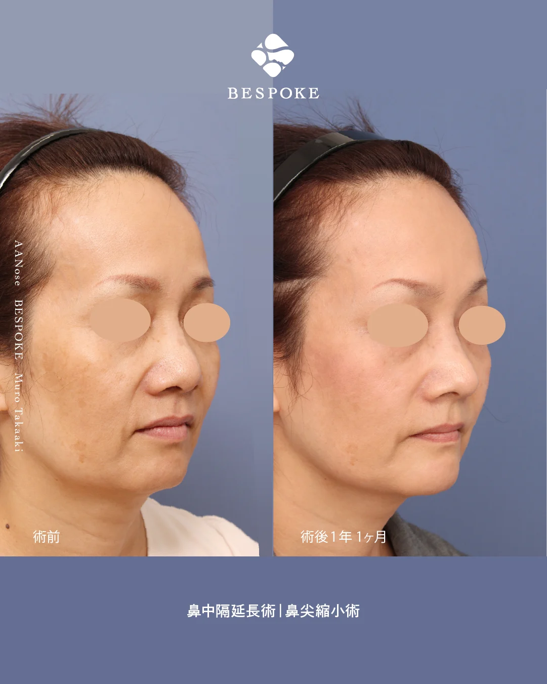 鼻中隔延長・鼻尖縮小2