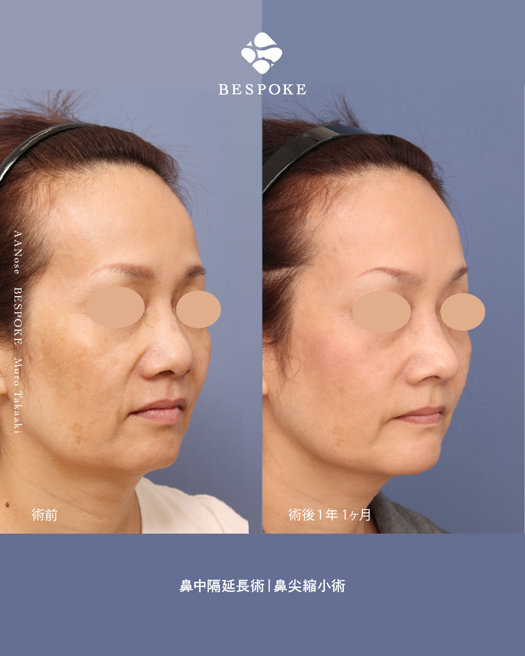 鼻中隔延長・鼻尖縮小2 鼻中隔延長術、鼻尖縮小術で加齢で広がる鼻を改善した症例