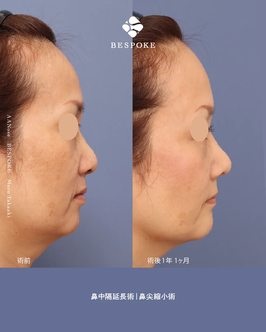 鼻中隔延長・鼻尖縮小3