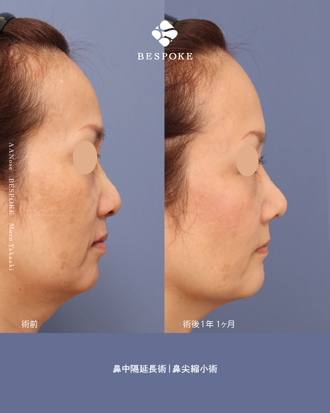 鼻中隔延長・鼻尖縮小3 鼻中隔延長術、鼻尖縮小術で加齢で広がる鼻を改善した症例