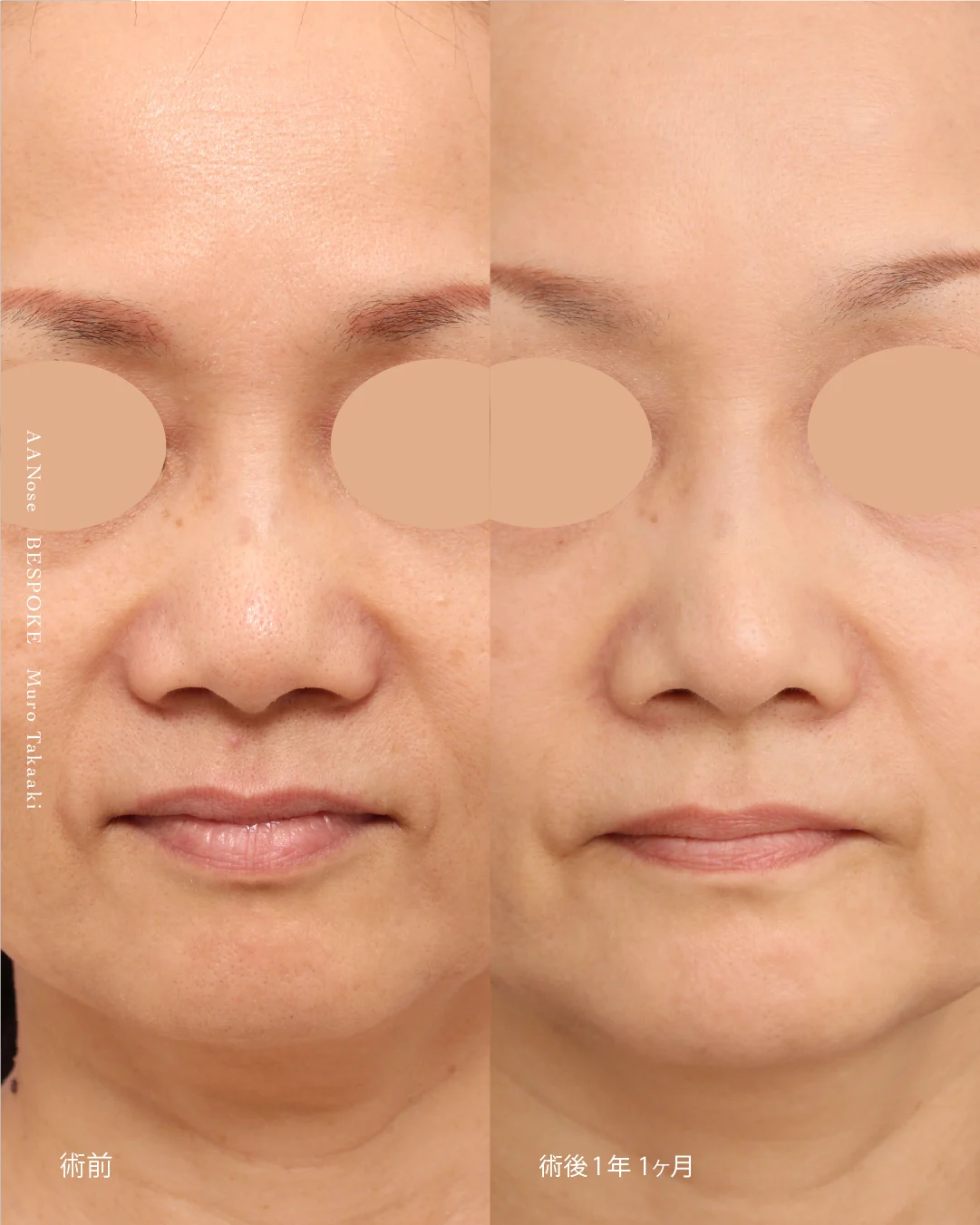 鼻中隔延長・鼻尖縮小4