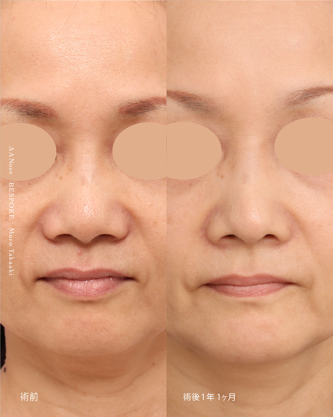 鼻中隔延長・鼻尖縮小4 鼻中隔延長術、鼻尖縮小術で加齢で広がる鼻を改善した症例
