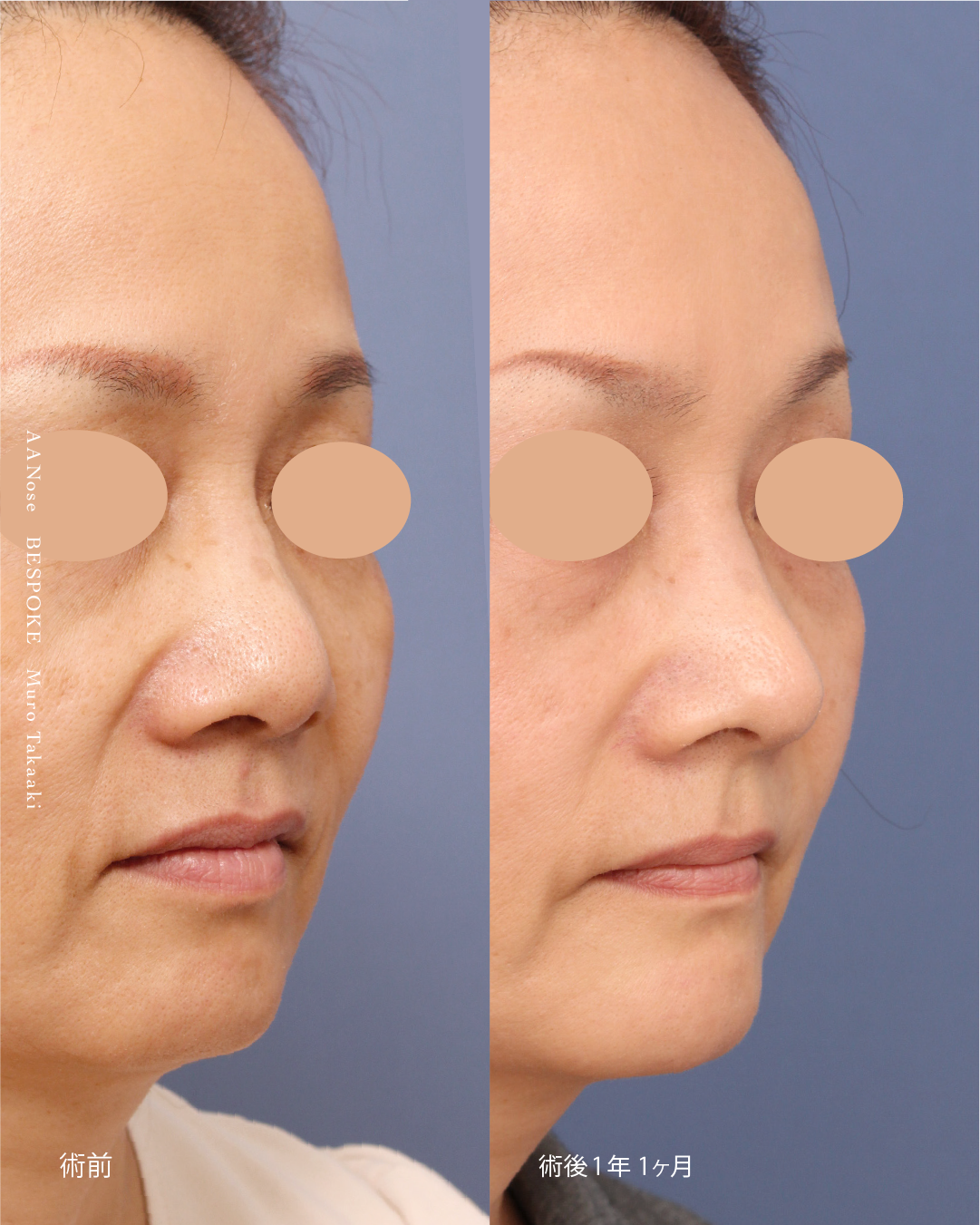 鼻中隔延長・鼻尖縮小5 鼻中隔延長術、鼻尖縮小術で加齢で広がる鼻を改善した症例