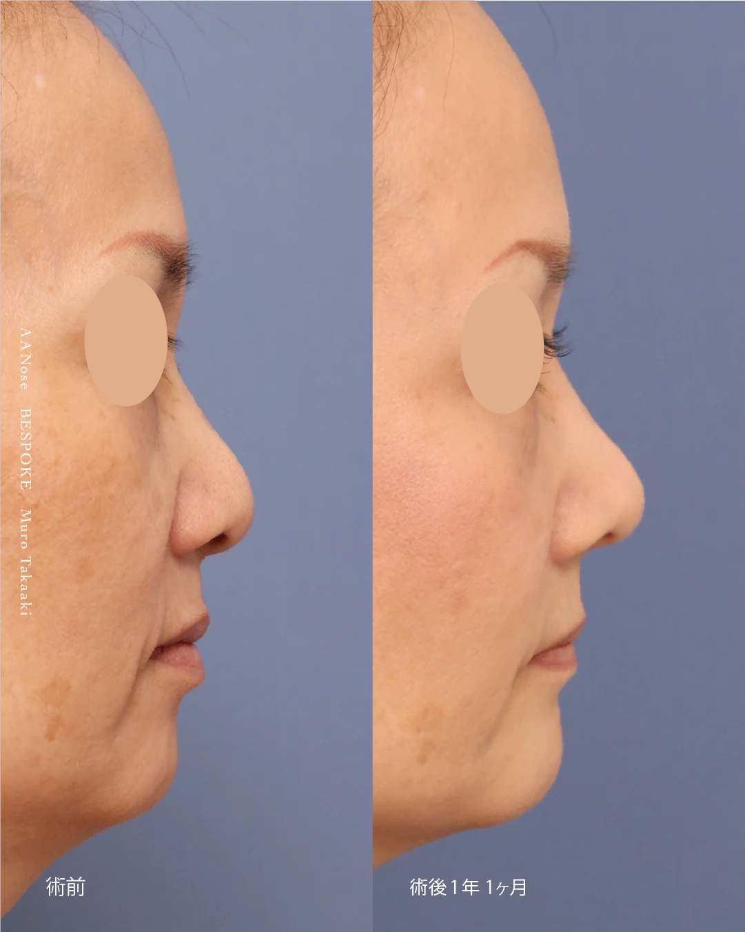 鼻中隔延長・鼻尖縮小6