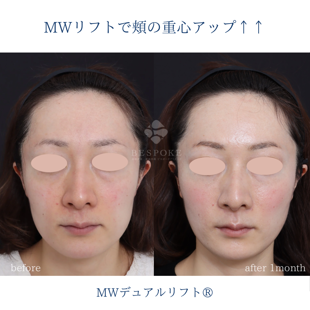 【MWデュアルリフト®】頬の重心を上へ。