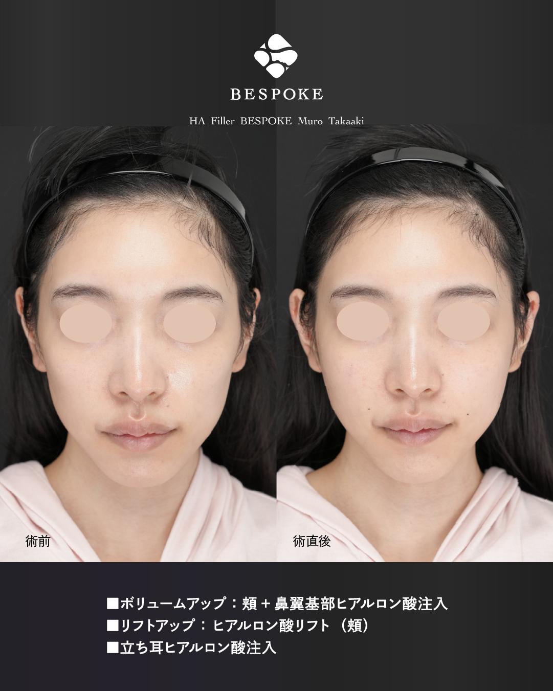 【ヒアルリフト/立ち耳】小さな変化、大きな違い