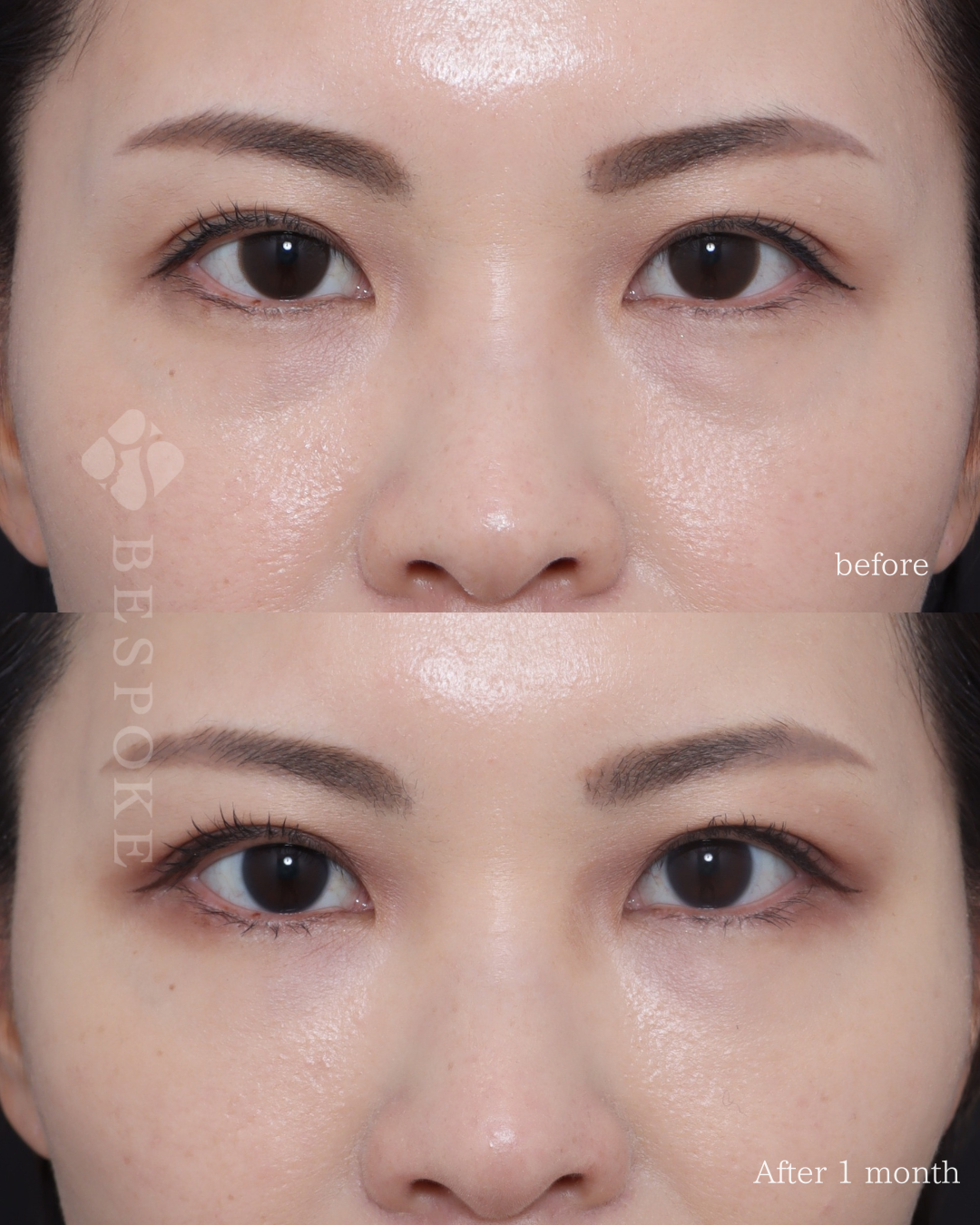 【ベビーコラーゲン注入】目の下の凹つきによるクマを改善。