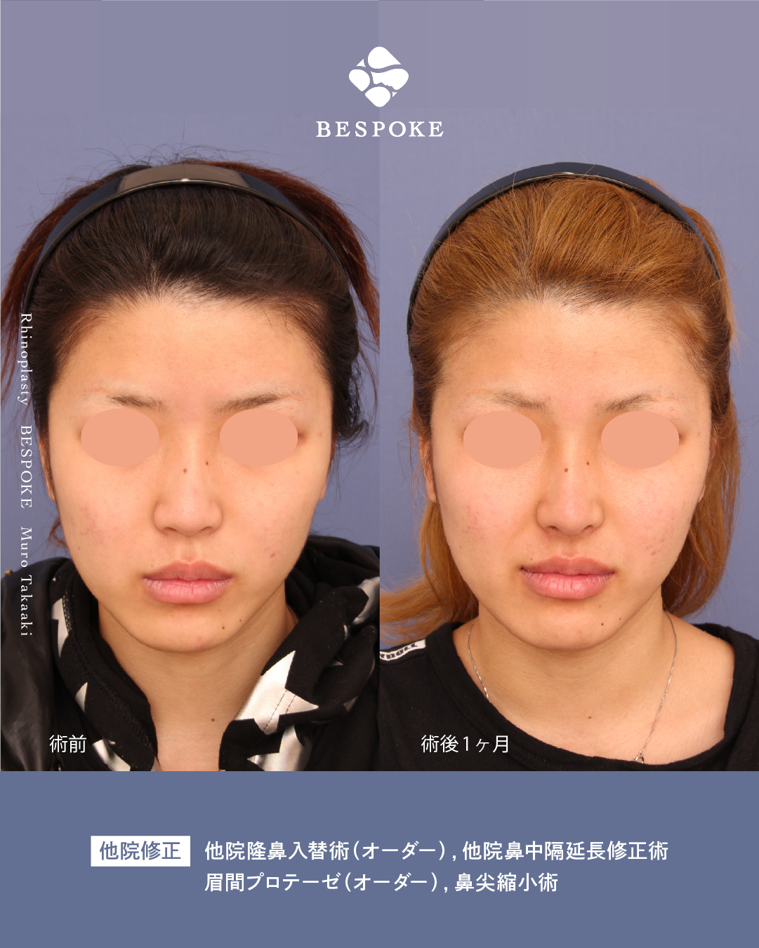 【鼻】”ちゃんと変わる”でも、自然に。