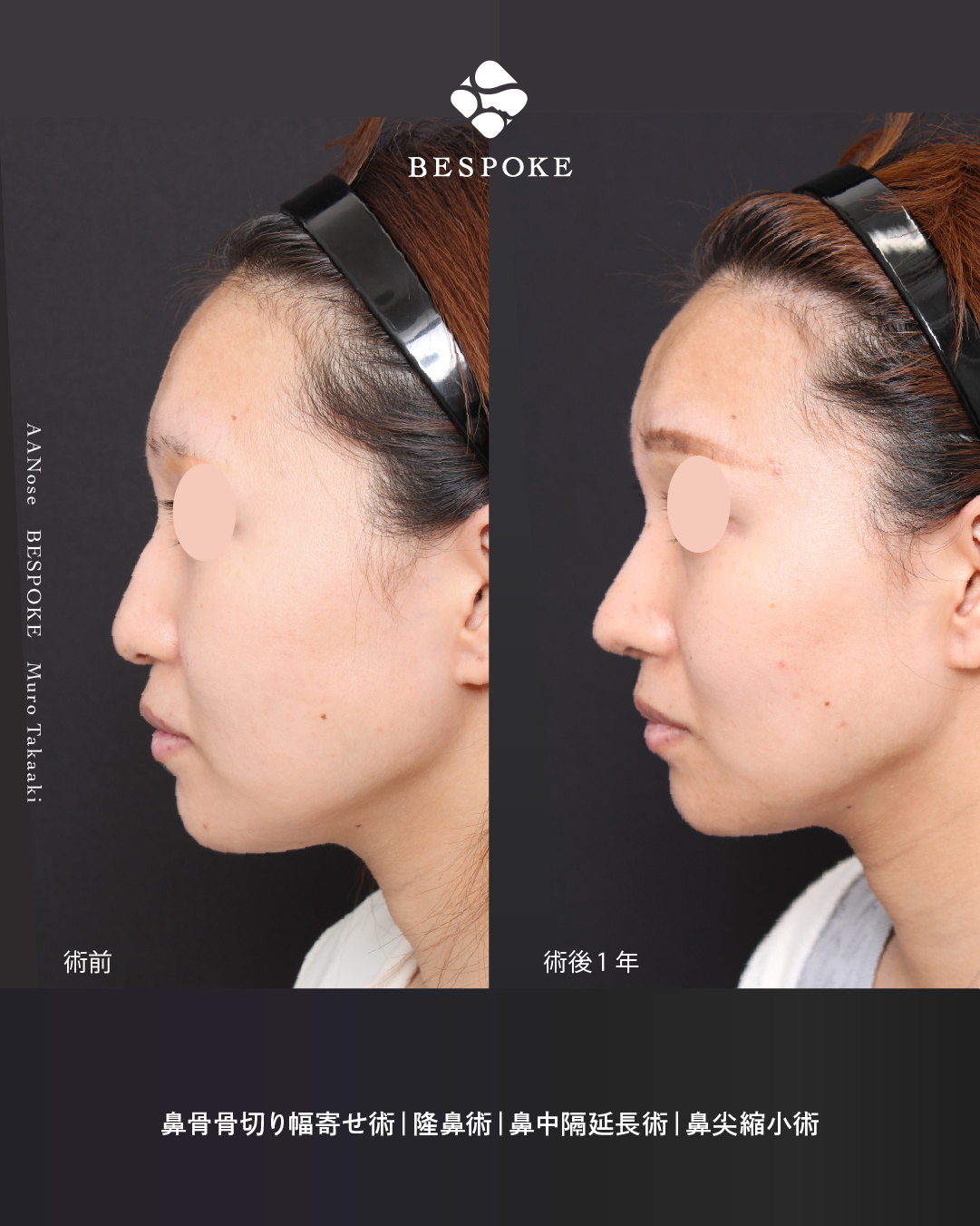 【アンチエイジングノーズ（AA Nose）】”鼻の存在感”が、ある理由