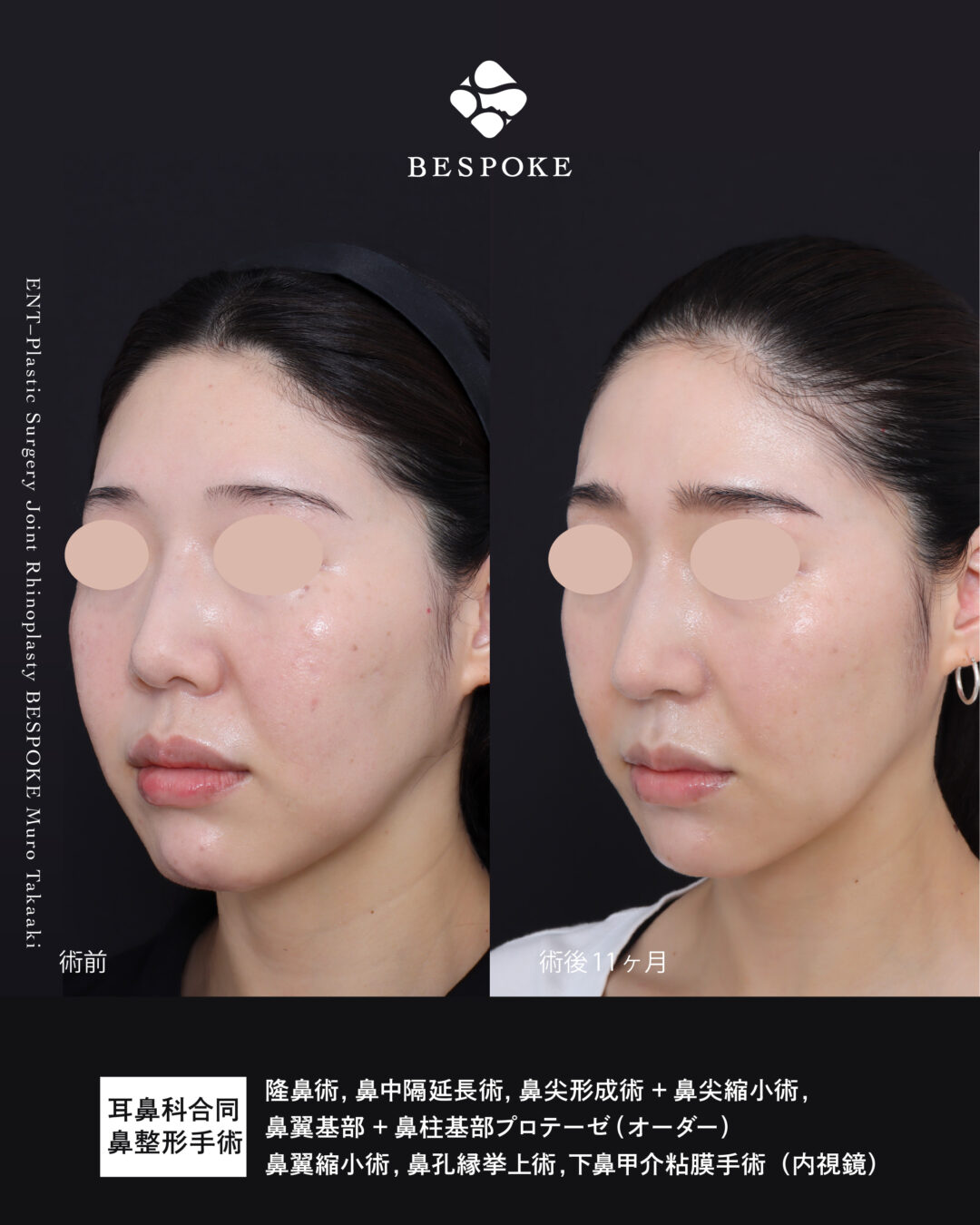 【鼻】品よくシャープな形と、ひどい鼻炎の改善