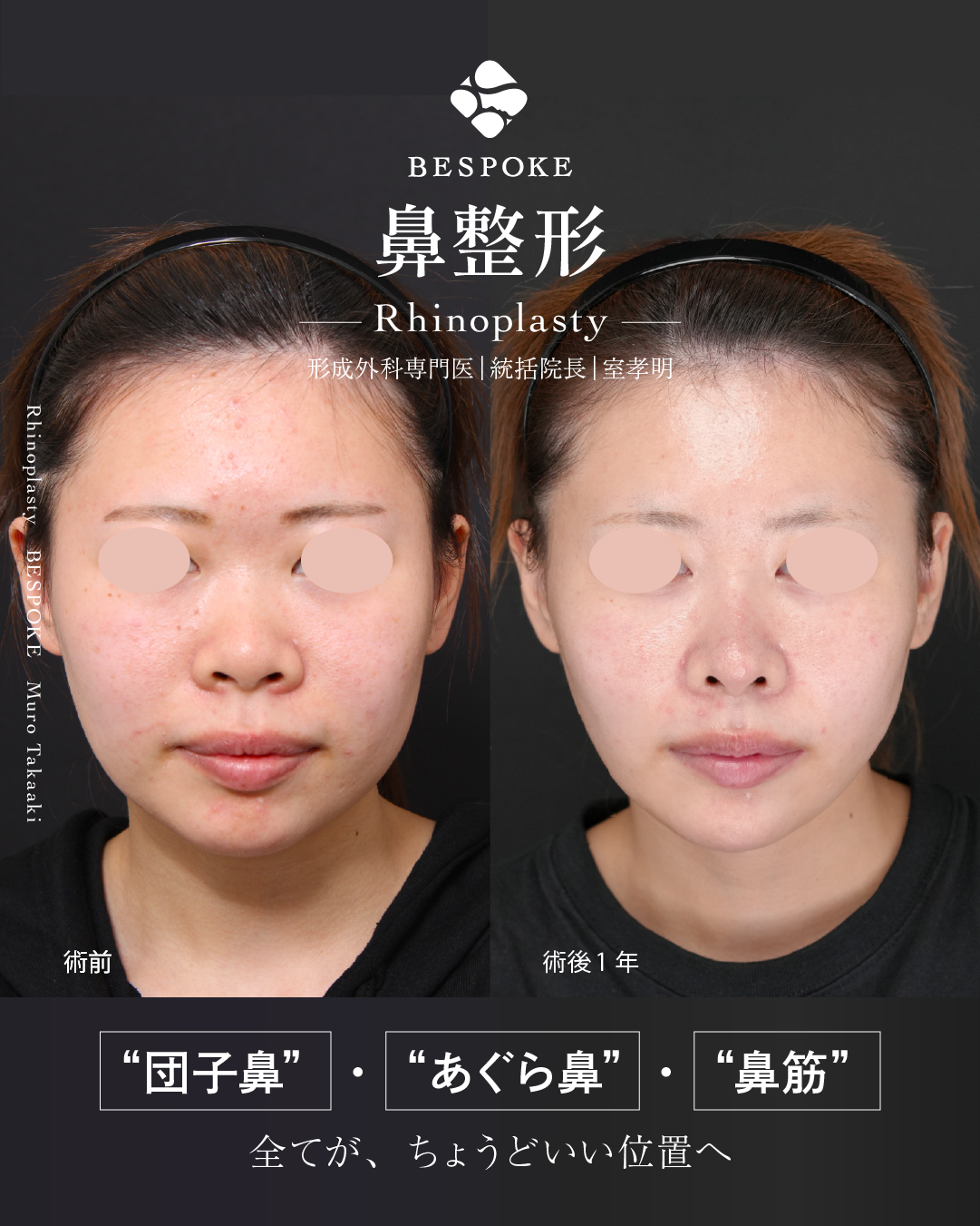 鼻整形症例-団子鼻とあぐら鼻と鼻先の位置 (1)