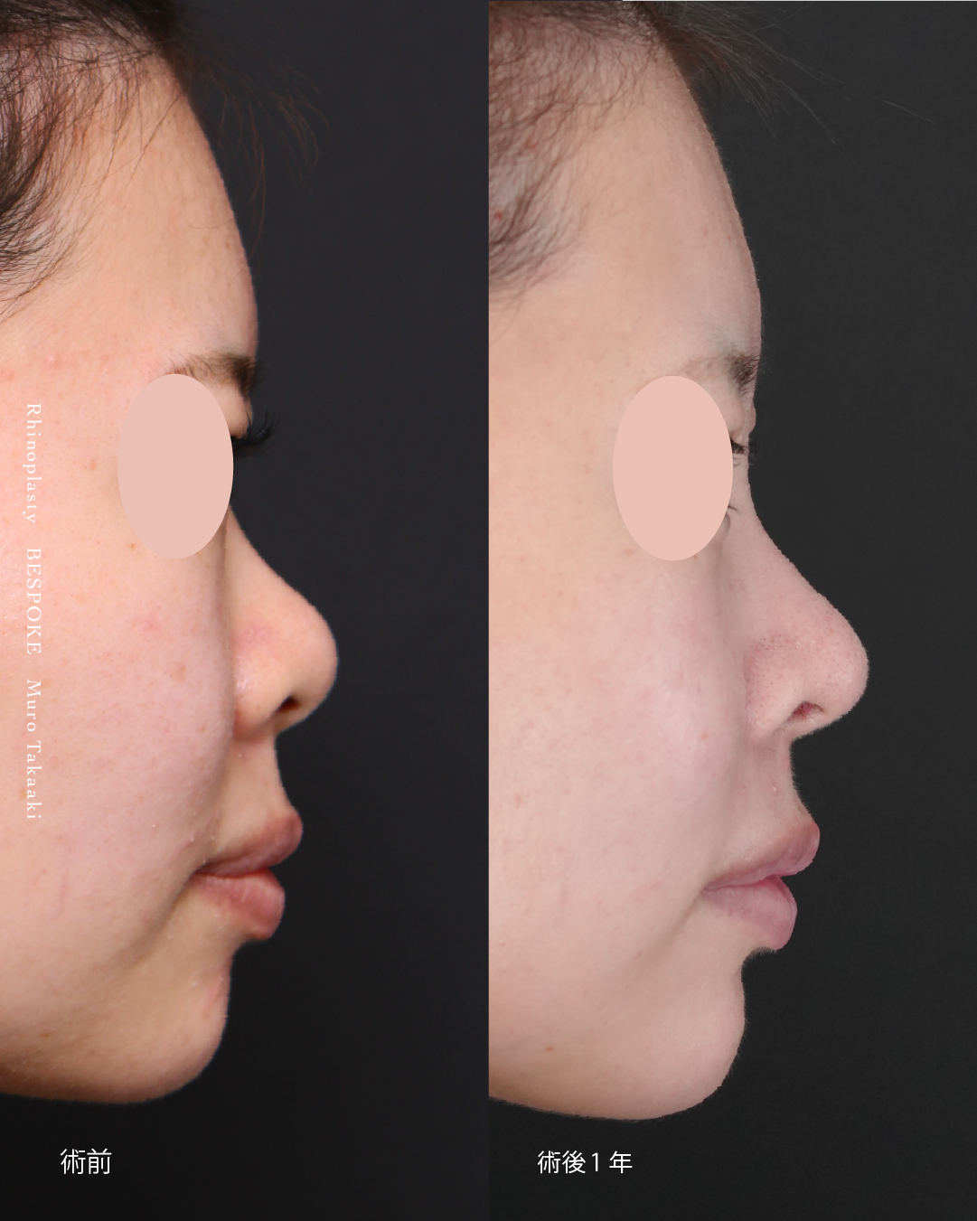 鼻整形症例-団子鼻とあぐら鼻と鼻先の位置 (2)