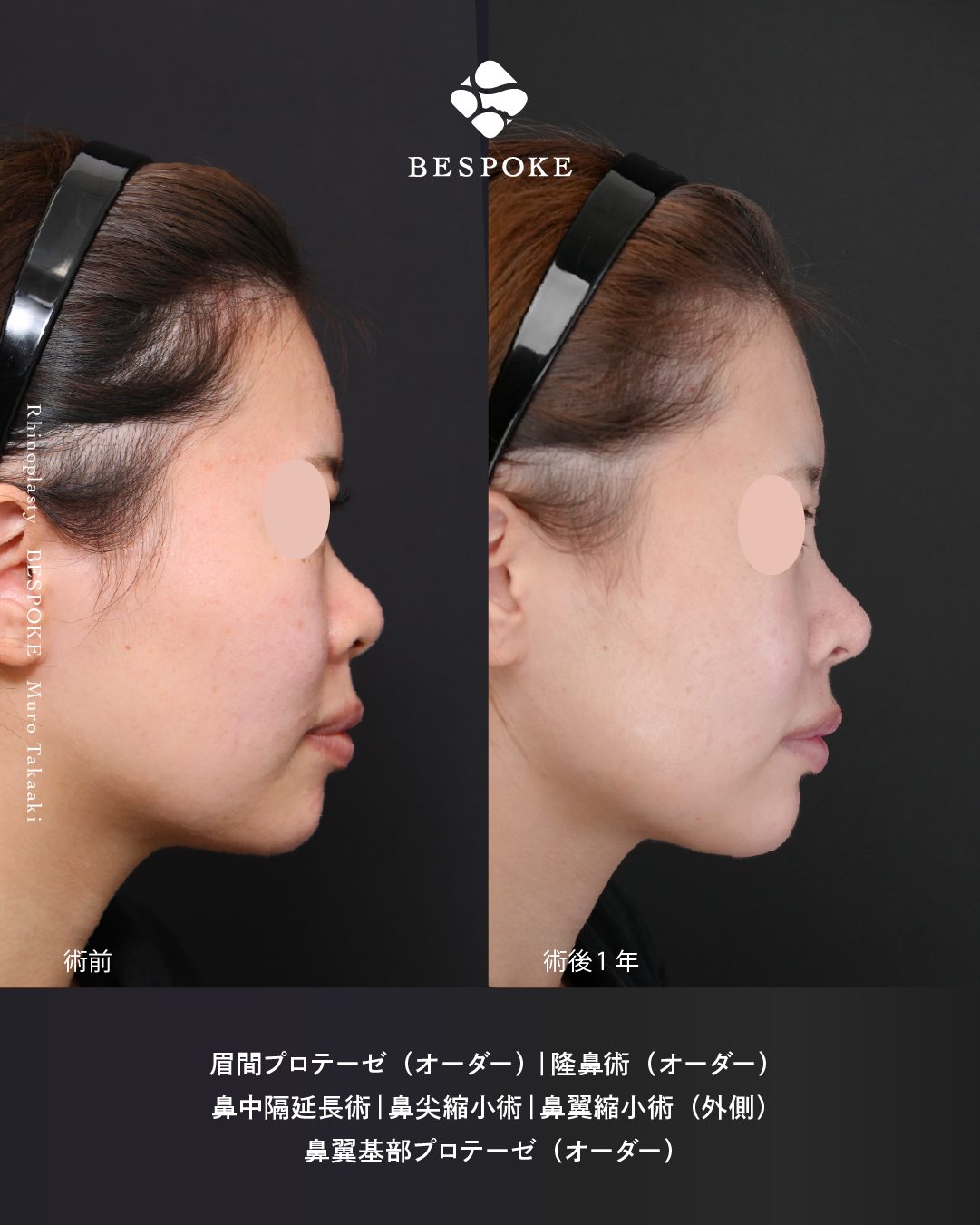 鼻整形症例-団子鼻とあぐら鼻と鼻先の位置 (5)