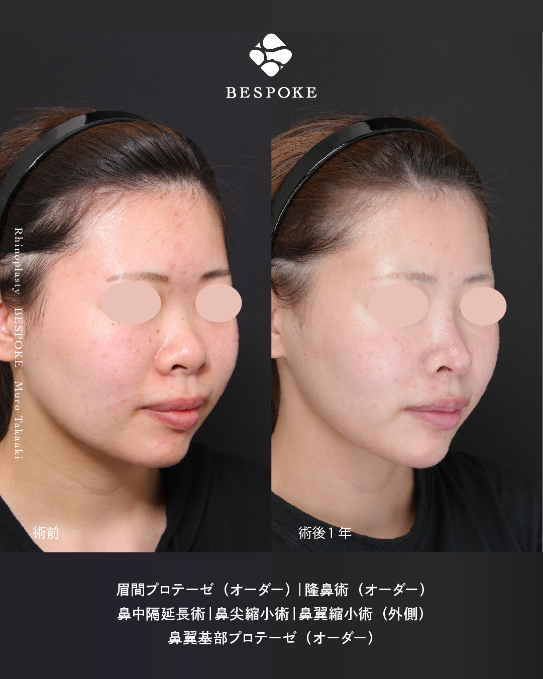 鼻整形症例-団子鼻とあぐら鼻と鼻先の位置 (6)