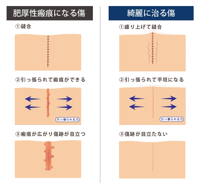 キズアトにお悩みの方へ。形成外科専門医の傷跡修正 - 福岡 東京渋谷 