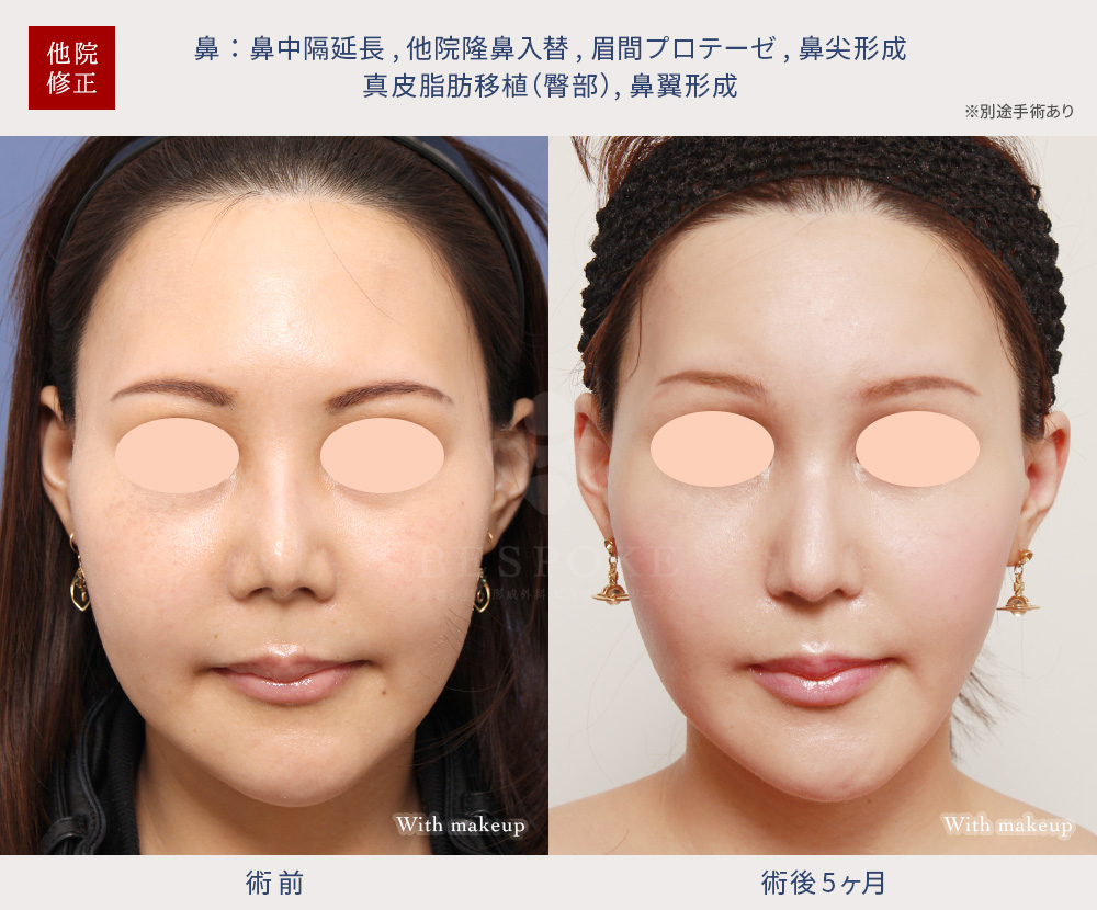 【鼻】ピンチノーズ様変形を伴う鼻尖拘縮の修正手術