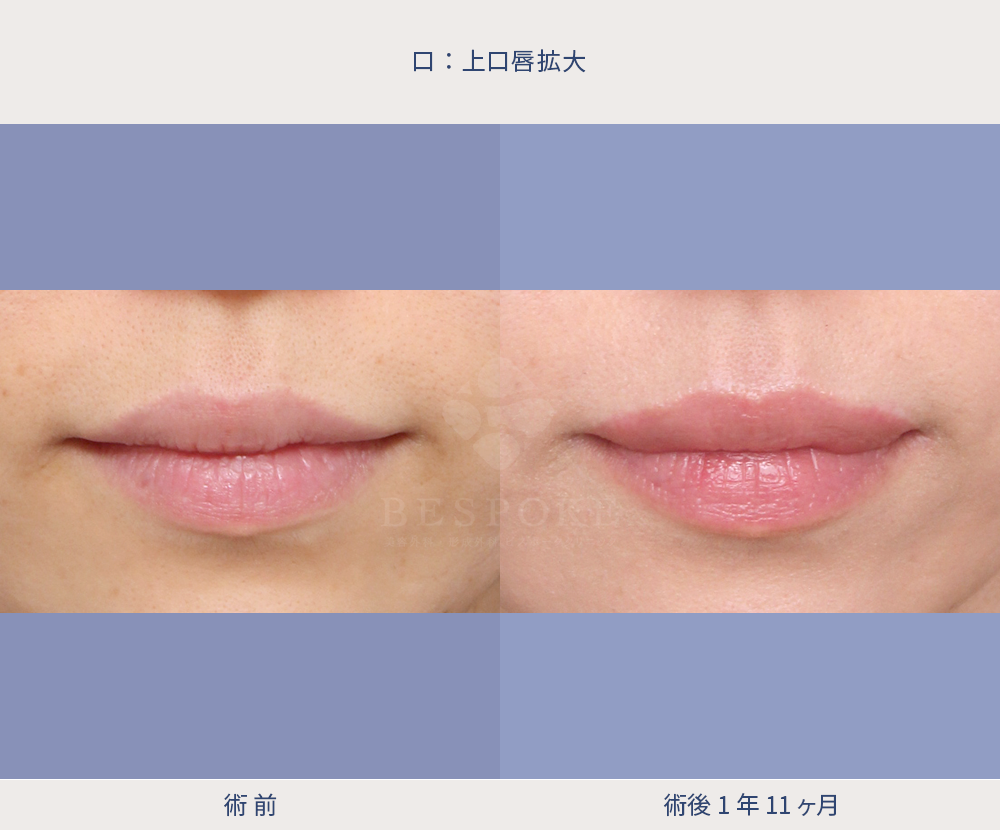 【上口唇拡大術】上くちびるをボリュームアップして、中顔面を狭く
