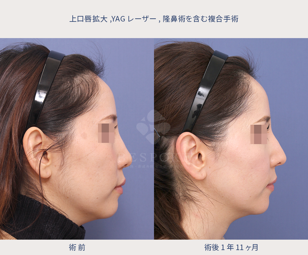 上口唇拡大 (2)