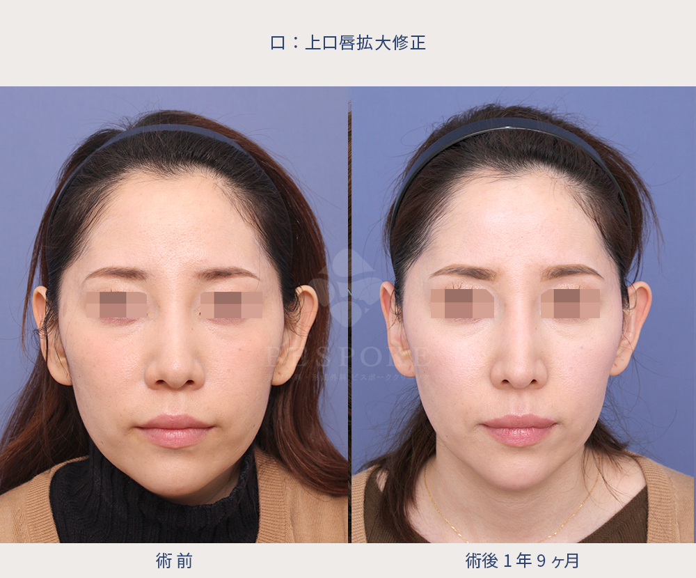 上口唇拡大 (4)
