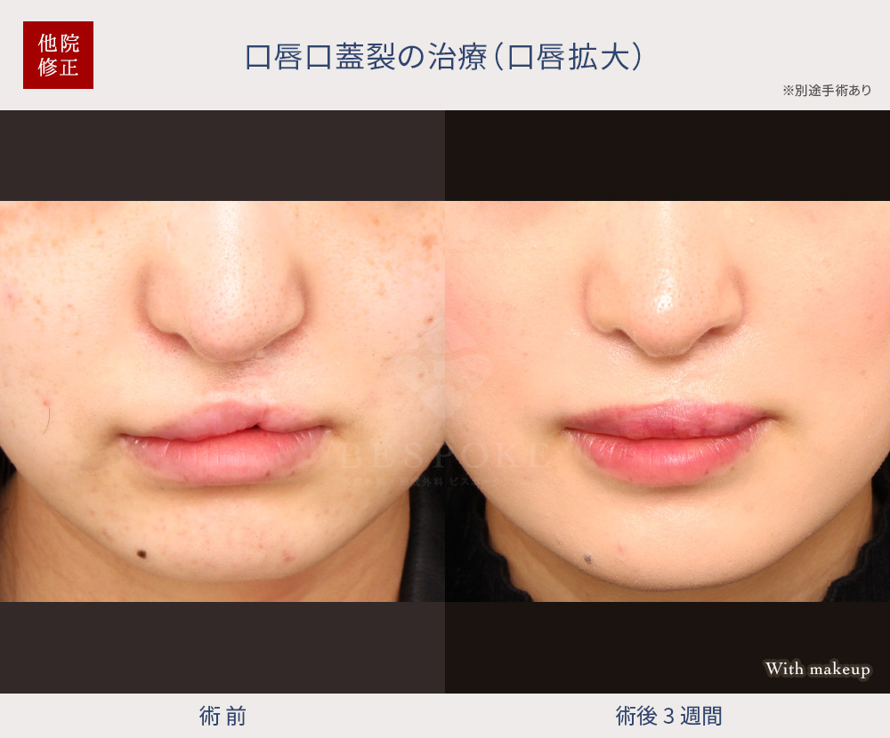 【口唇拡大術】生まれつきの唇裂（しんれつ）の見た目を改善