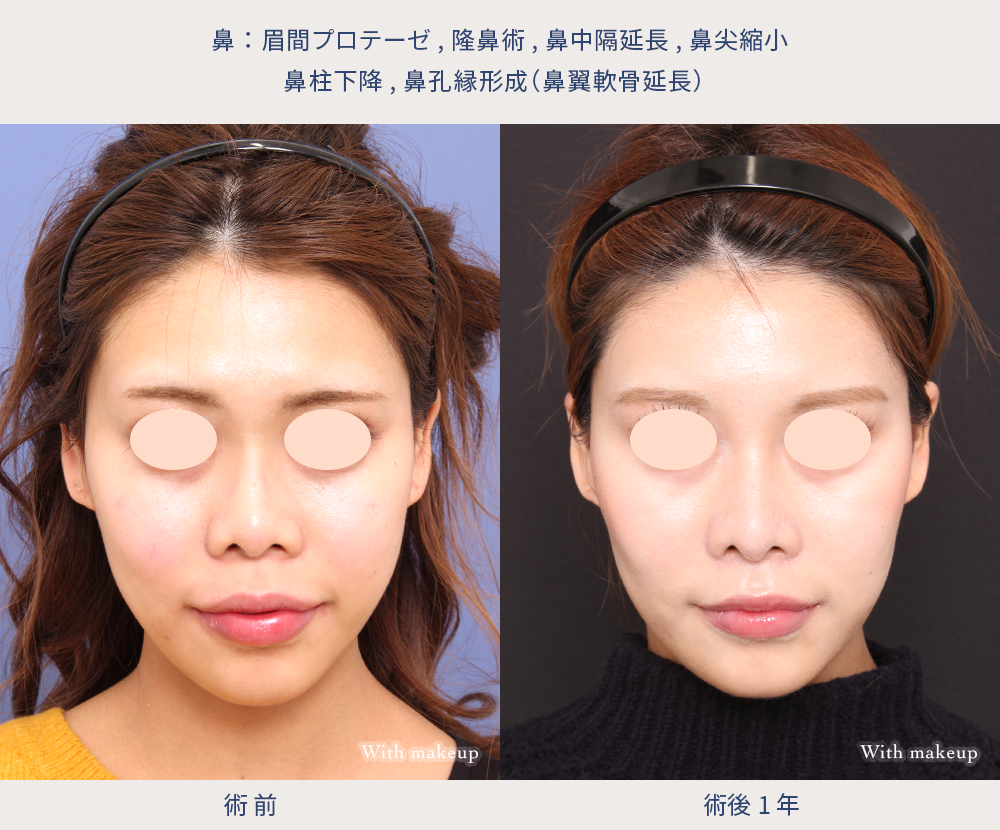 眉間プロテーゼ・隆鼻・鼻中隔延長・鼻尖縮小・鼻柱下降・鼻孔縁形成2-1