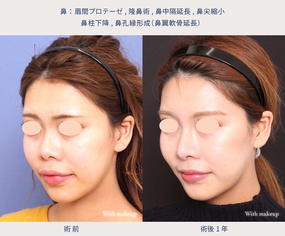 【鼻】鼻先を下げて顔の印象を変える