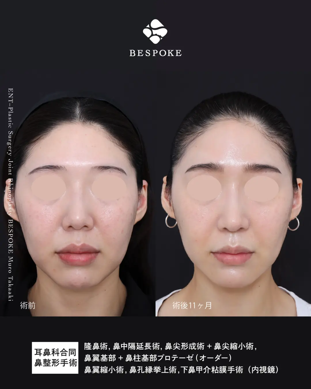鼻整形症例 (4)