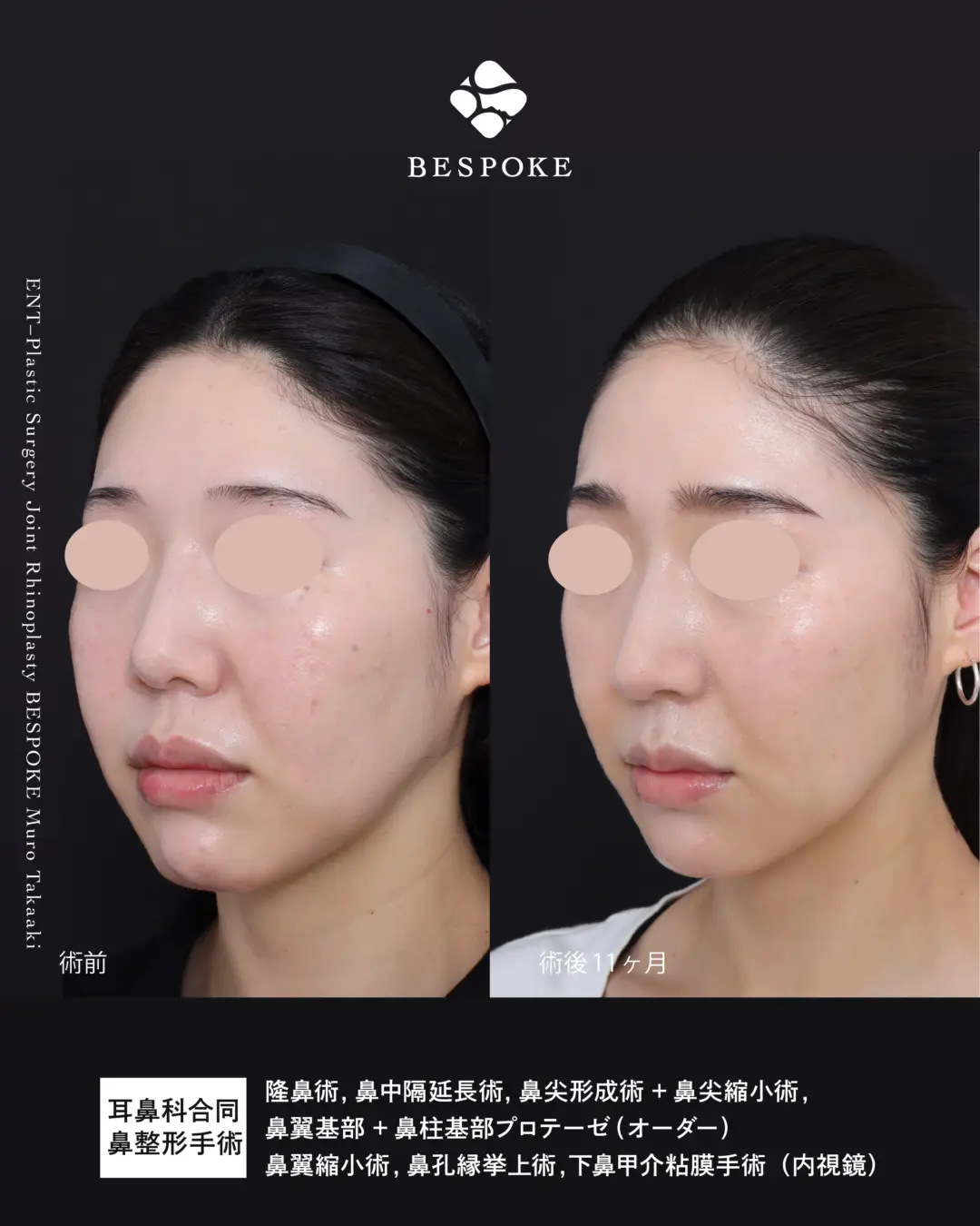 鼻整形症例 (5)