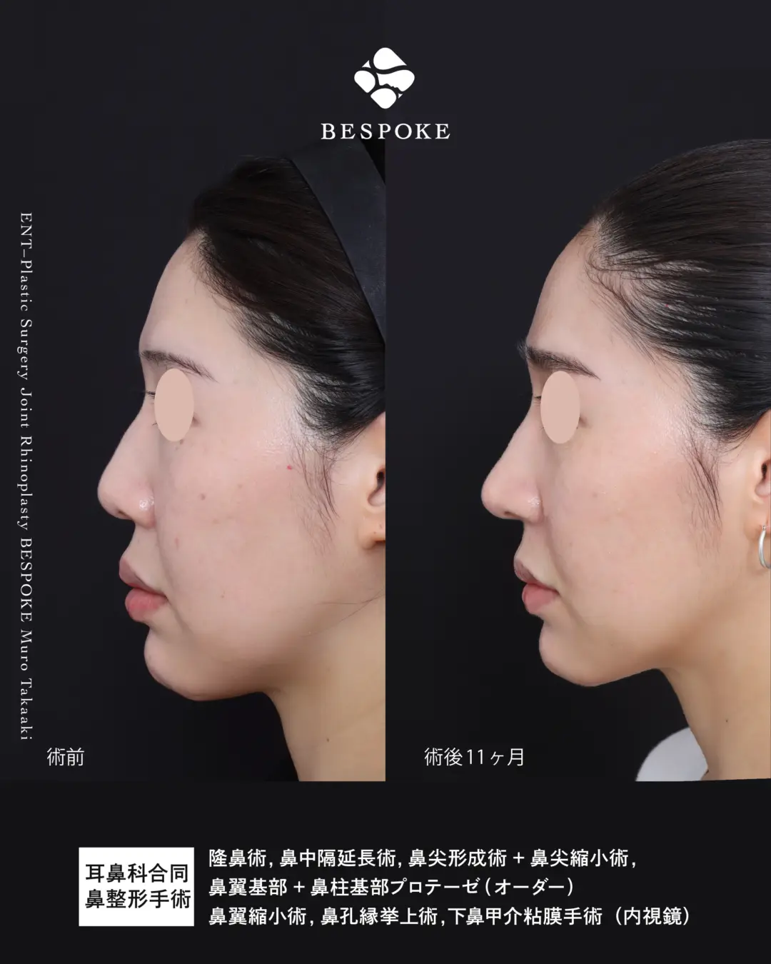 鼻整形症例 (6)