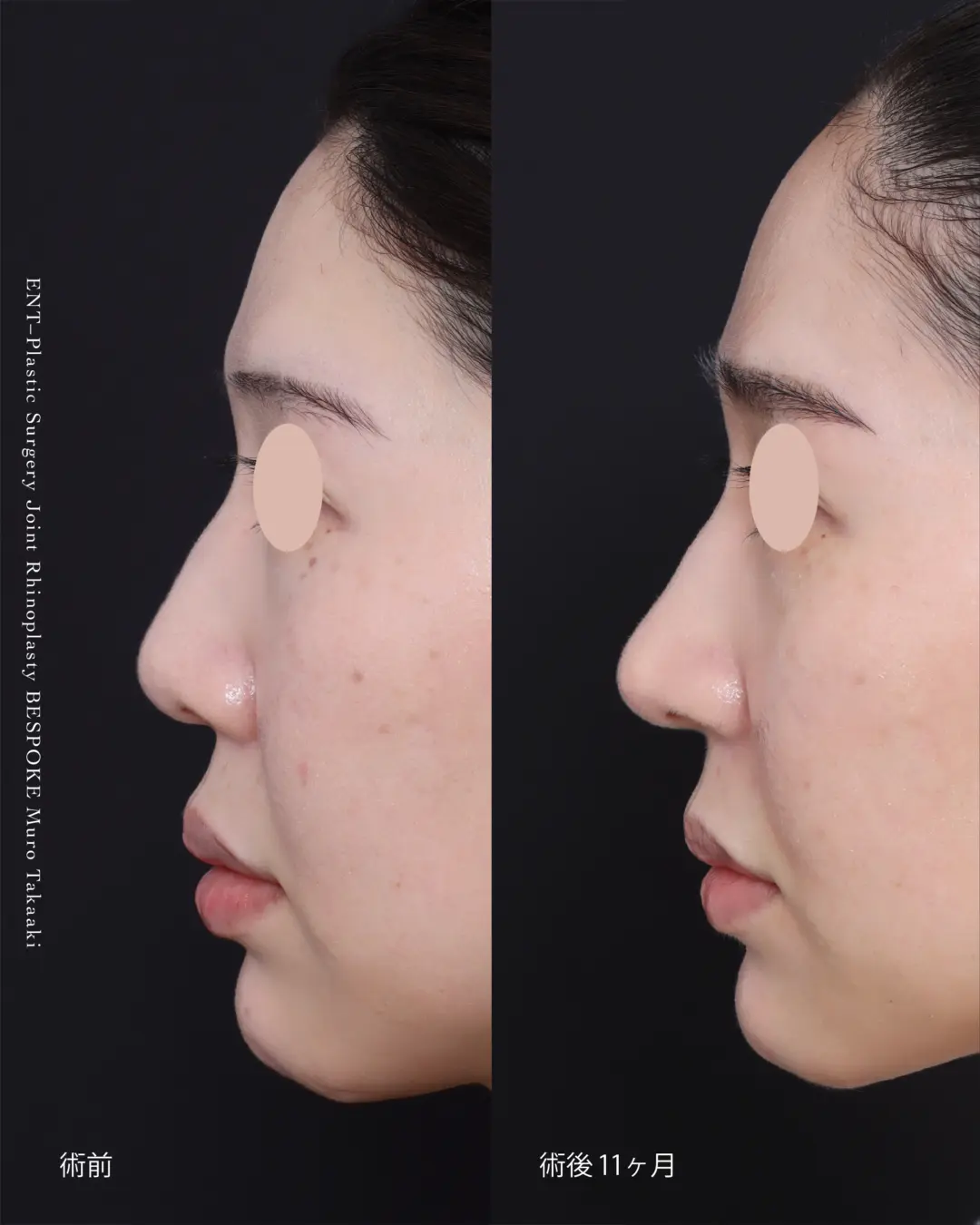 鼻整形症例 (7)