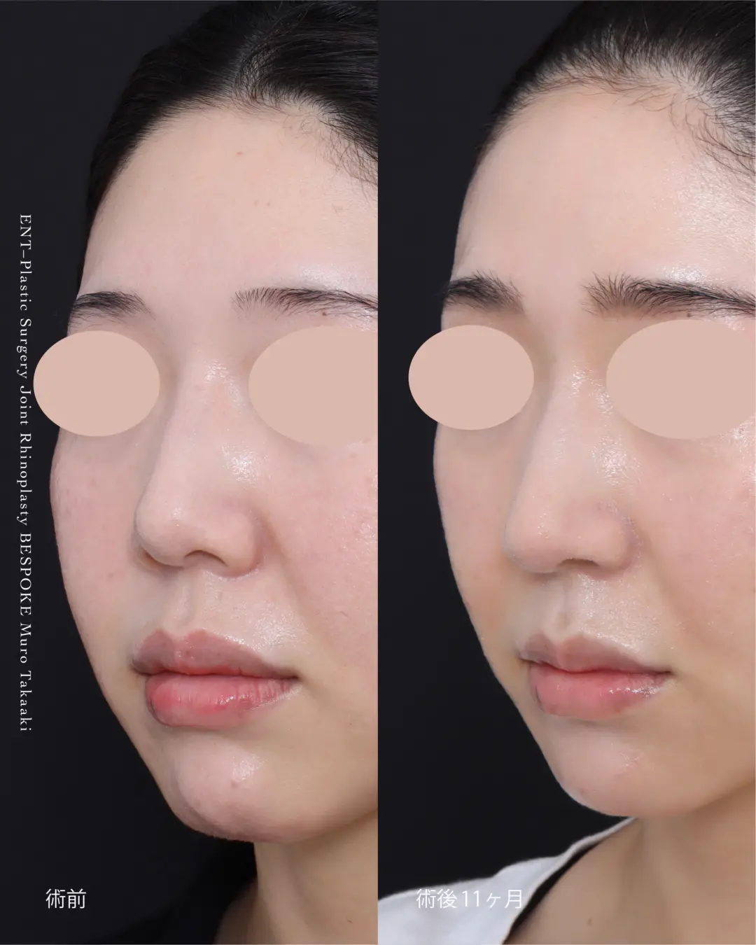 鼻整形症例 (8)