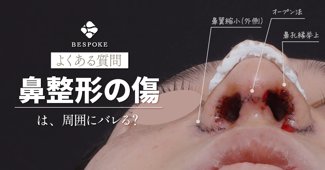 【症例写真】鼻整形の傷跡は目立つ？小鼻縮小・オープン法など部位別に検証