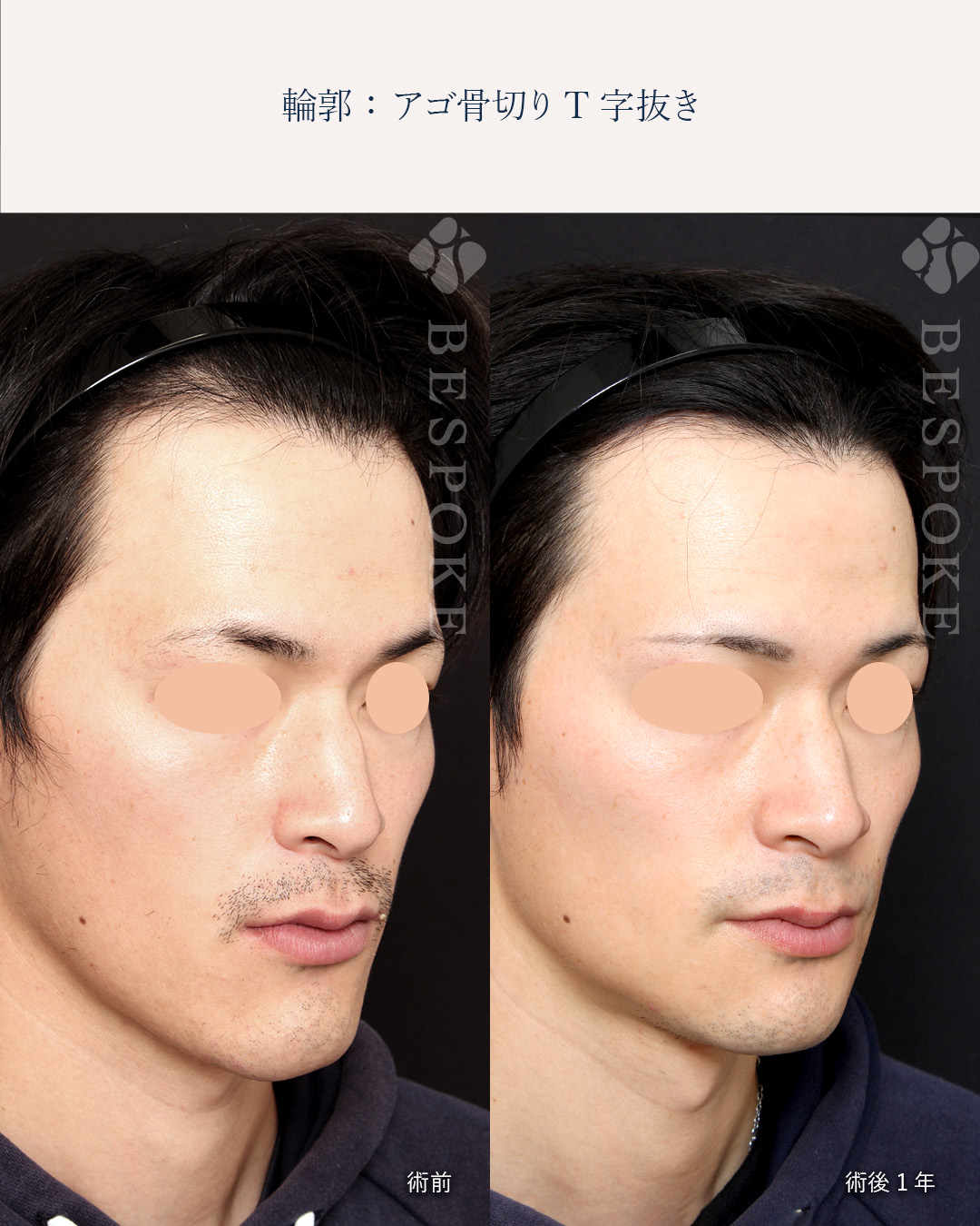 メンズ整形_顎骨切T字抜き2